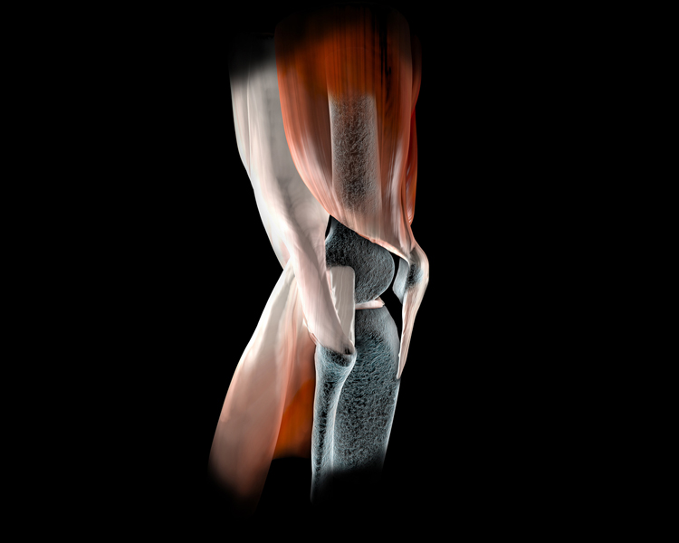 Knieverletzungen - Knochen